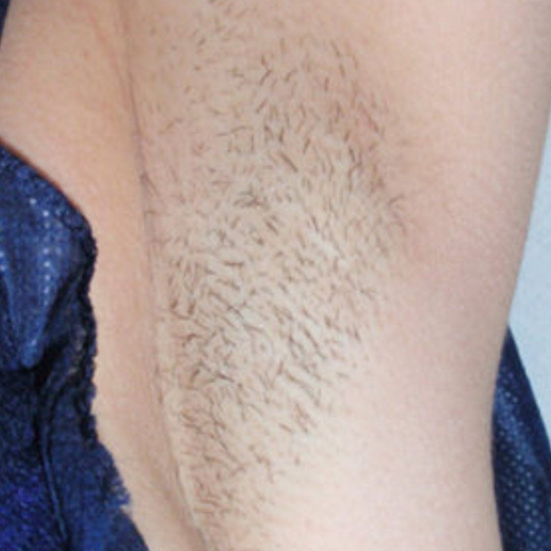 Hair Removal Formula (6).png__PID:898c0f8b-3921-44a1-ad1f-86b78c77efd8